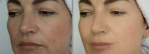 Microdermabrasion Ergebnis