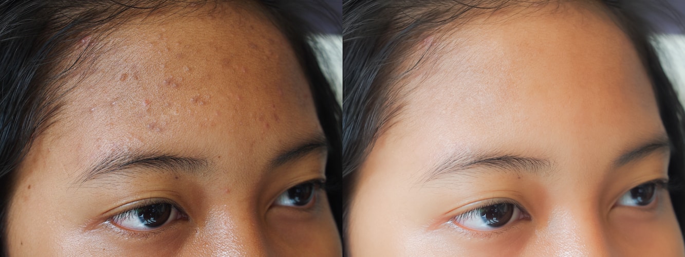 Microdermabrasion München » das besondere Peeling