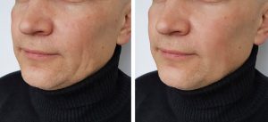 Microdermabrasion Männer Ergebnis