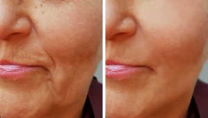 Microneedling Ergebnis