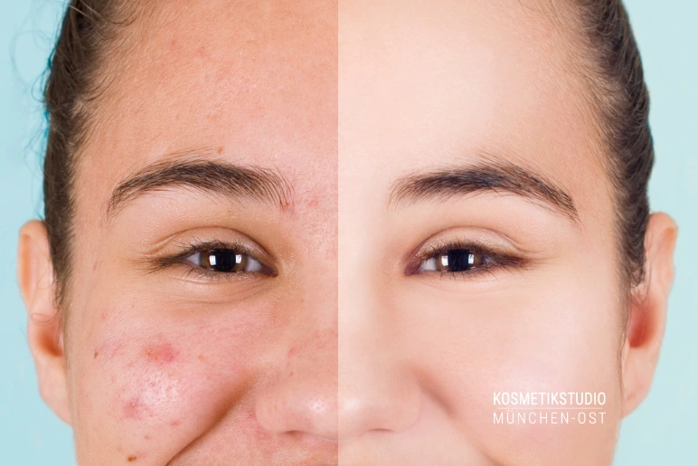 Junge Frau mit Aknenarben vor und nach einer Microneedling Behandling im Kosmetikstudio München Ost